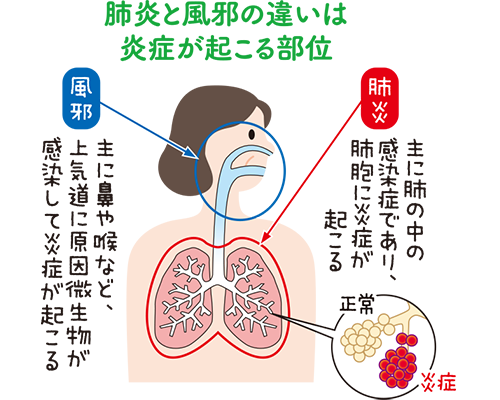 肺炎と風邪の違いは炎症が起こる部位